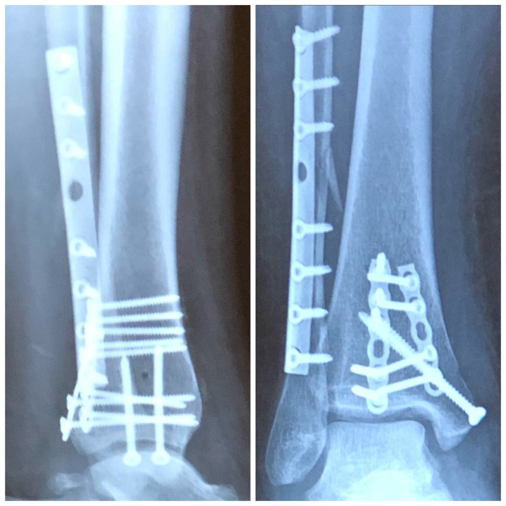 Broken Ankle Surgery Recovery After Trimalleolar Fracture - Whole ...